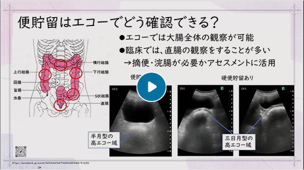 排便ケア　はじめての看護エコー　排便エコー編