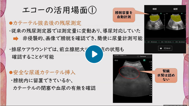 はじめての看護エコー　排尿エコー編